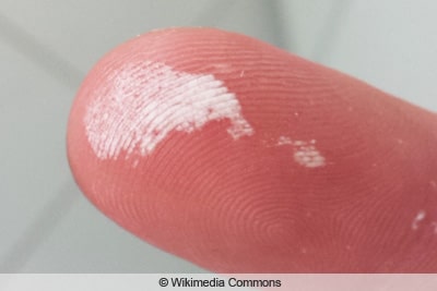 Finger mit Wunde durch Wasserstoffperoxid
